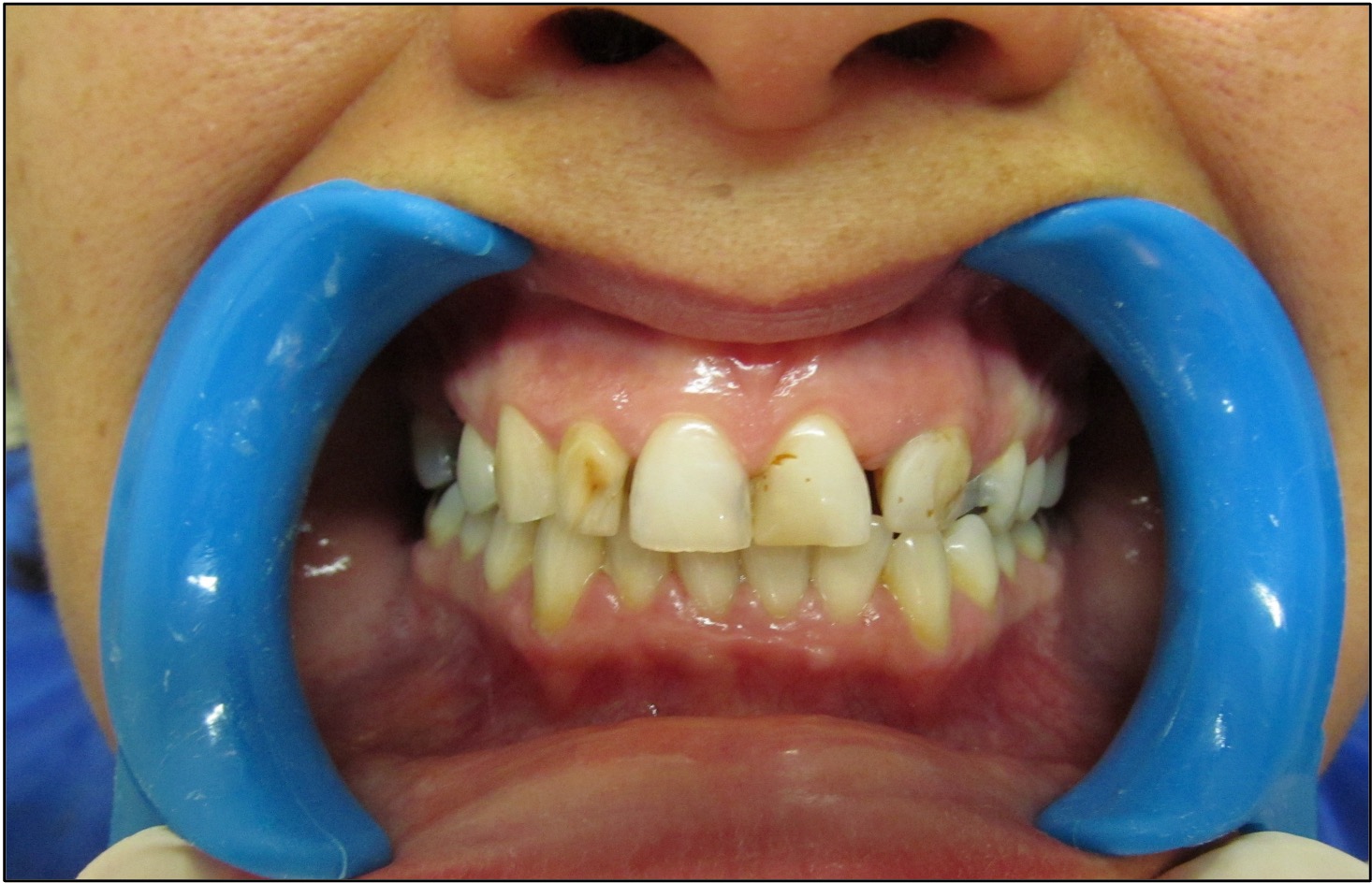 ODONTOSHOT Antes