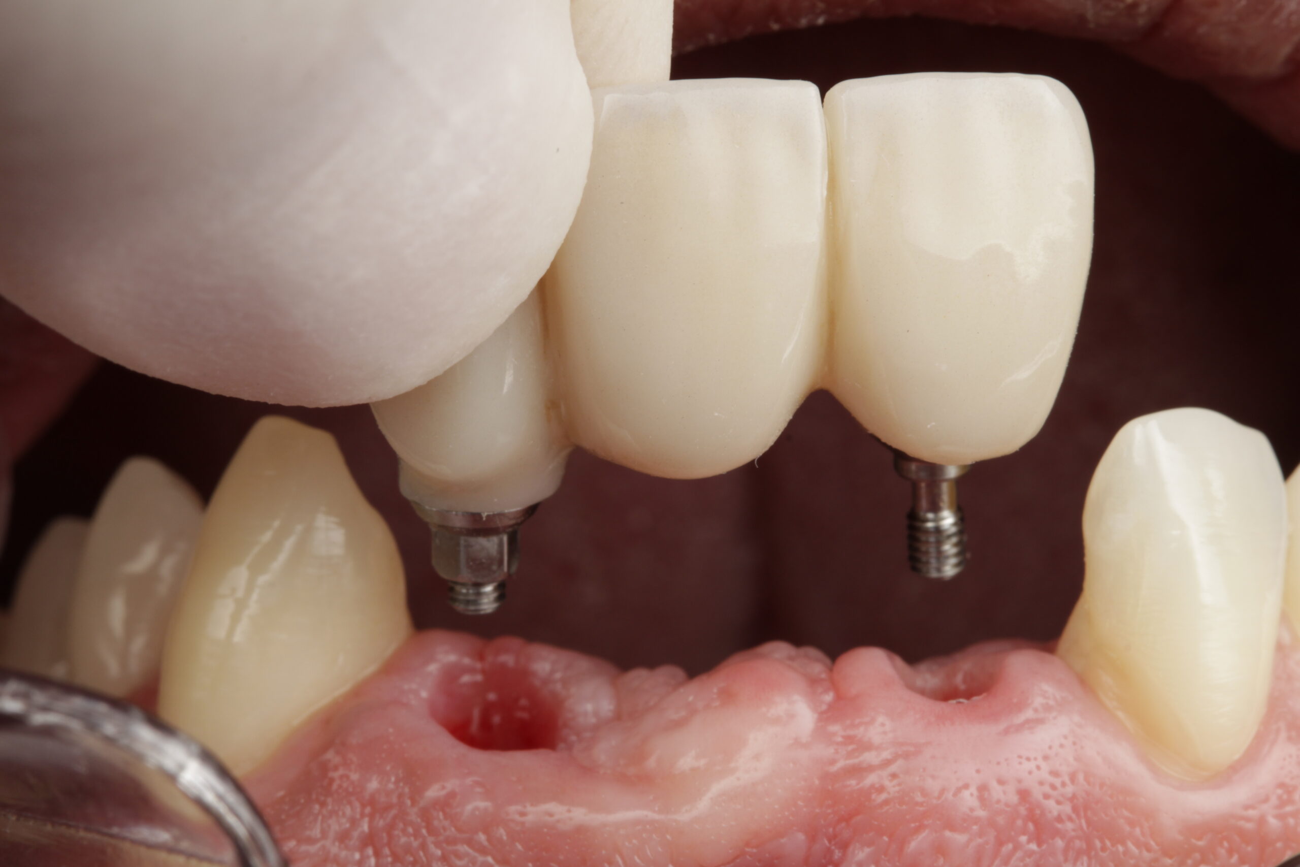 Implante dental fotografiado