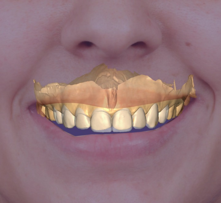 Diseño de sonrisa